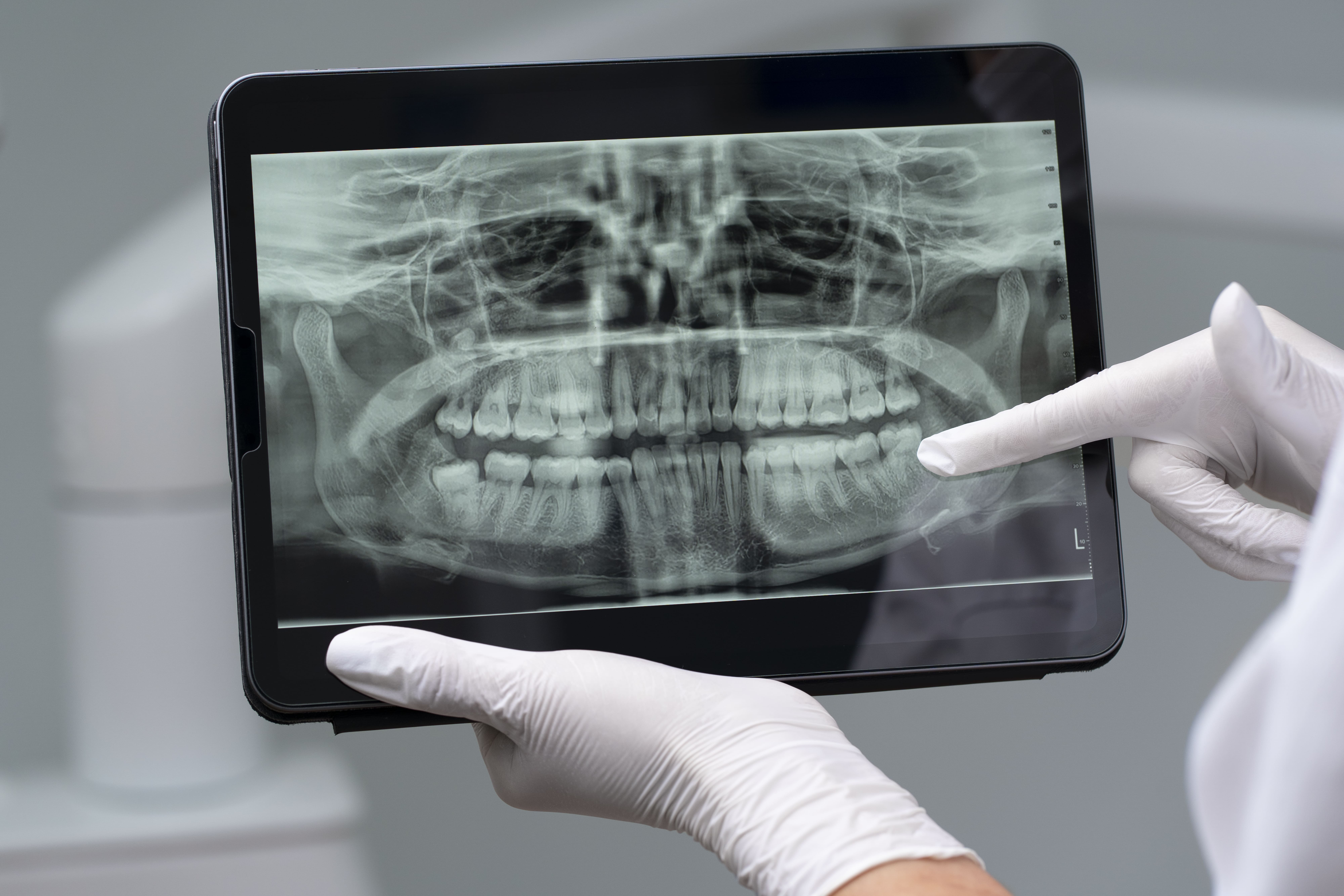 X‑Ray OPG Scan in Bengaluru
